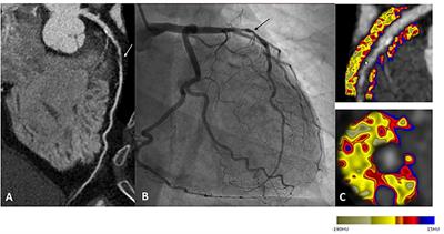 Non-invasive Multimodality Imaging of Coronary Vulnerable Patient